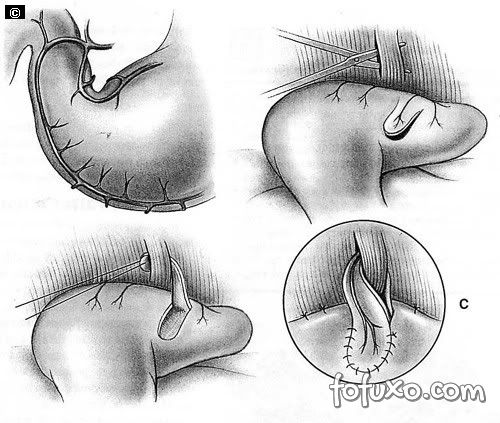 desrotação cirúrgica e fixação do estômago à parede do abdómen
